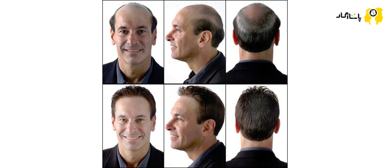روش های ترمیم مو برای موهای کم پشت